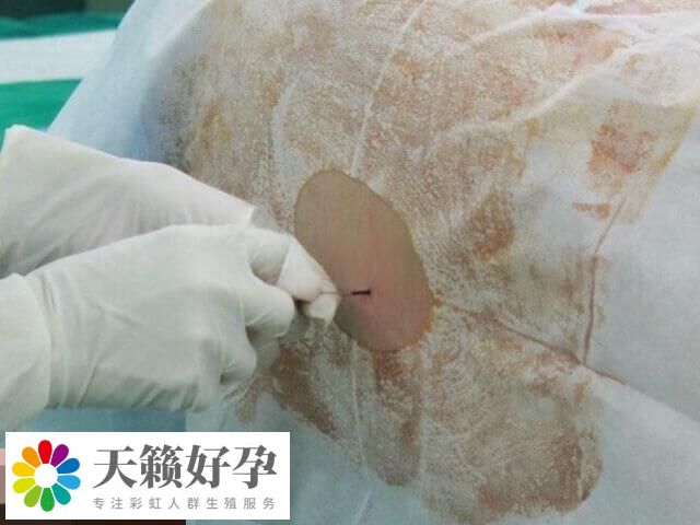 宮腔鏡是一種微創性婦科診療技術